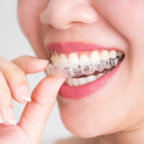 Teeth whitening mouth - 4,